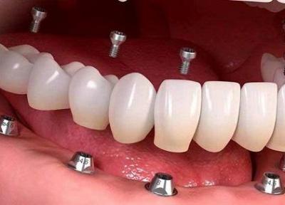 فراوری ایمپلنت دندان در مرکز رشد دانشگاه صنعتی ارومیه خبرنگاران