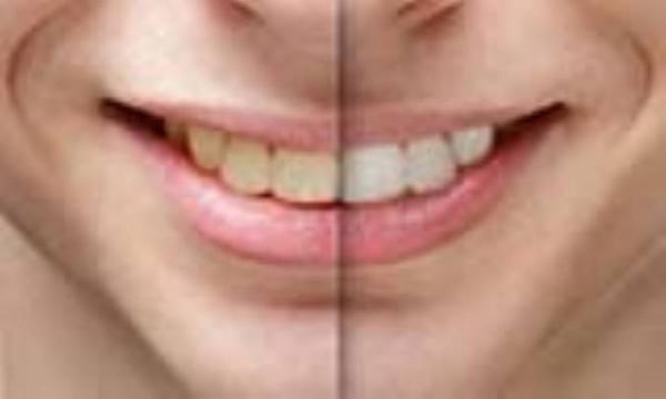 معایب سفید کردن دندان